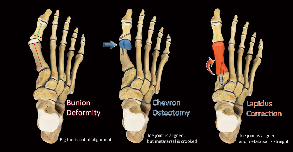 chevron osteotomy