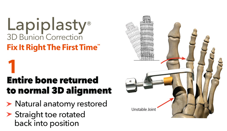 Lapiplasty