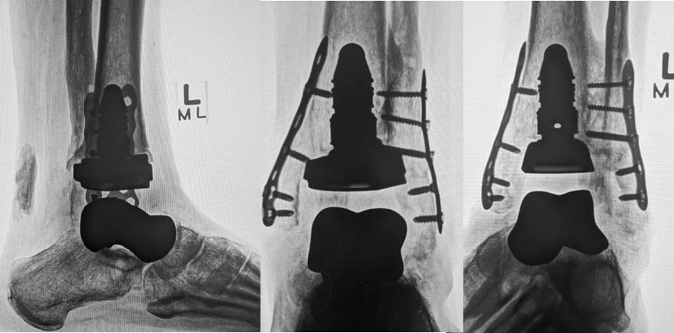 8 weeks postop. Weightbearing x-rays