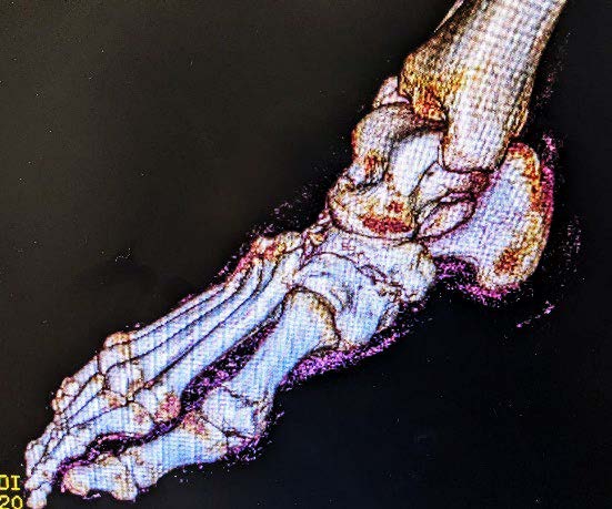 3D Scan - Foot and Ankle Reconstruction