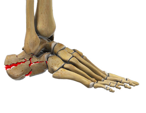 Heal Bone Fractures (Calcaneal Fractures)