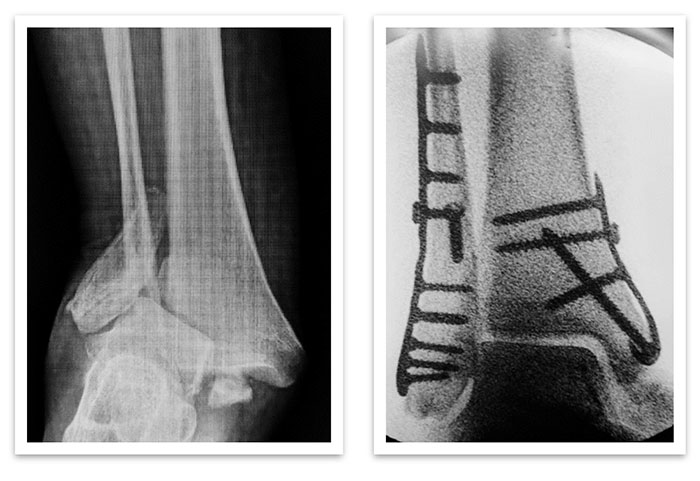 ankle fracture xray