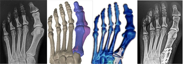 bunion xray