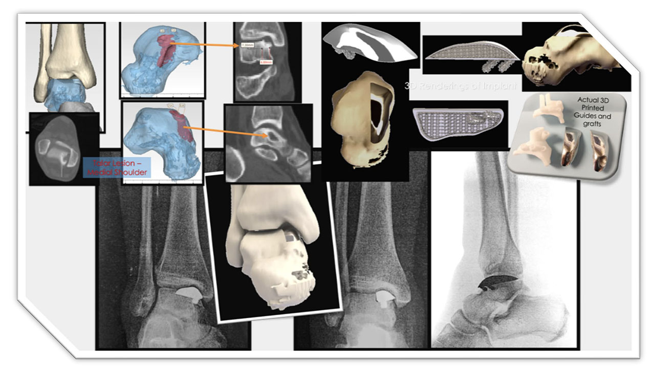 Partial Ankle collage