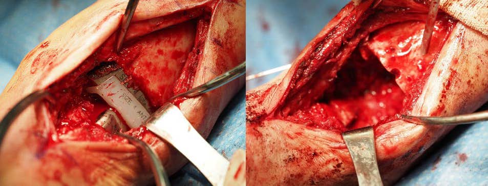 Agility imprint before (left) and after removal (right)