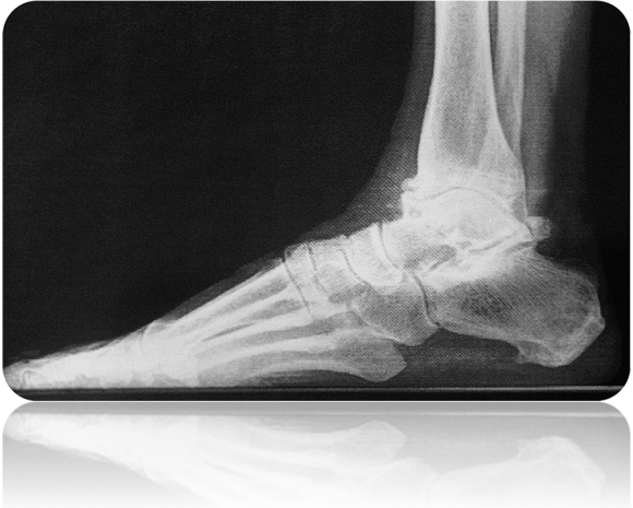 End stage ankle arthritis