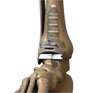 INBONE® Total Ankle Replacement 