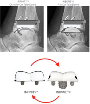 INFINITY® Total Ankle Replacement