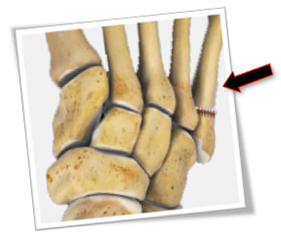 jones fracture