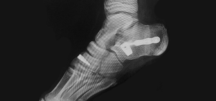 Forefoot/Midfoot Reconstruction