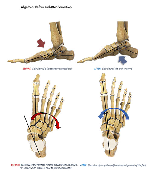 Adult acquired flatfoot deformity – fallen arches and flat feet treatments  – Caring Medical Florida