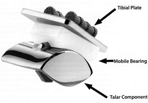 Stryker S.T.A.R.™ Total Ankle