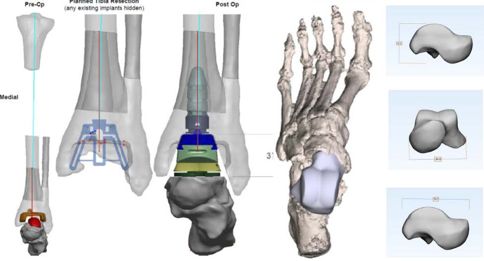 Wright Medical Prophecy Invision tibial plan