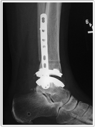 Zimmer Biomet Trabecular Metal Total Ankle Replacement Xray