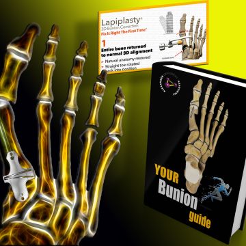 Customized 3D Bunion Reconstruction