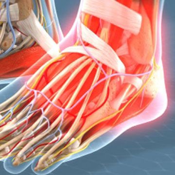 Ankle Replacement vs. Fusion for Arthritis